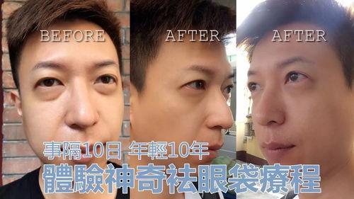 袪眼袋视频,告别眼部疲劳，焕发青春光彩